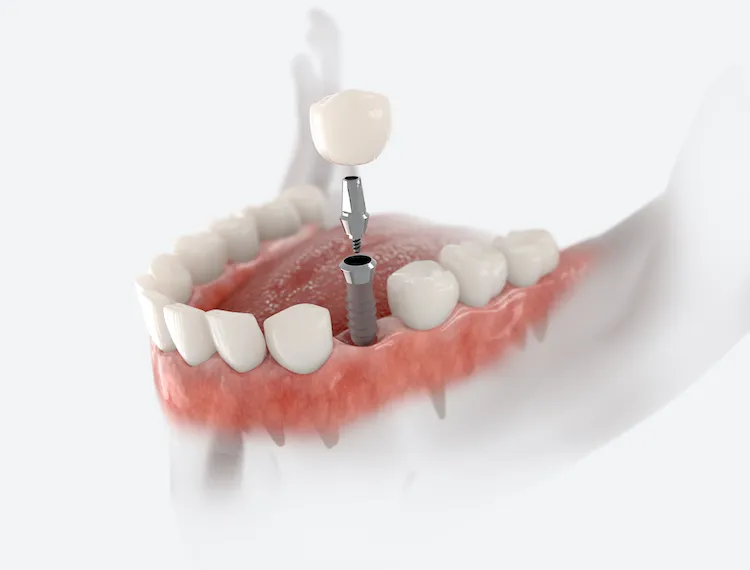 Is It Time to Think About Dental Implants?