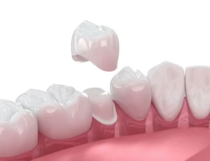 Signs Your Dental Crown Might Need Attention in Fort Wayne, IN