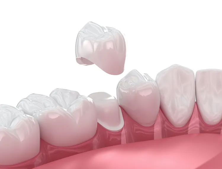 Signs Your Dental Crown Might Need Attention in Fort Wayne, IN