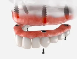 Dentures vs. Implants: Which One Is Right for You in Fort Wayne, IN