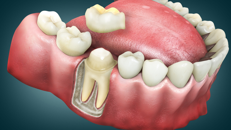 What Happens If You Skip the Crown After a Root Canal? A Fort Wayne Warning